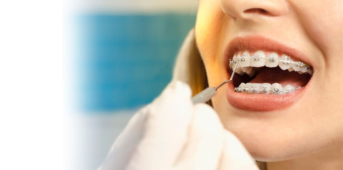 Conventional Metal Braces in Mysore at Umbrella Aesthetics